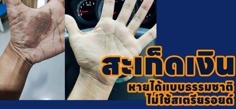 เคสสะเก็ดเงินที่หายโดยไม่ใช้สเตรียรอยด์